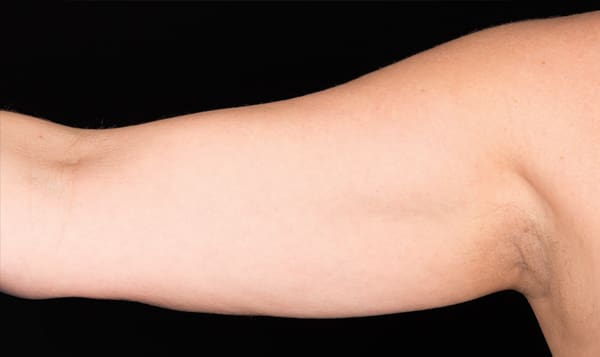 CoolSculpting® in West Palm Beach and Jupiter, FL