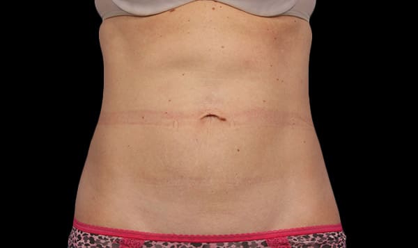 CoolSculpting® in West Palm Beach and Jupiter, FL