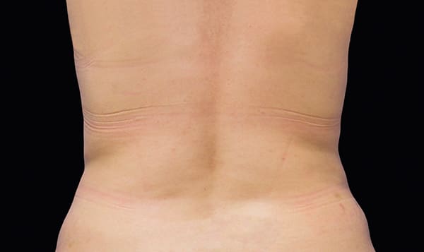 CoolSculpting® in West Palm Beach and Jupiter, FL