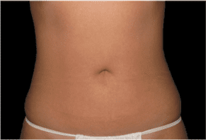 Liposuction Before and After Pictures West Palm Beach, FL (Dr. Eidelman)