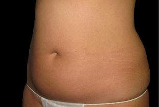 Liposuction Before and After Pictures West Palm Beach, FL (Dr. Eidelman)