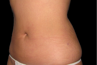 Liposuction Before and After Pictures West Palm Beach, FL (Dr. Eidelman)