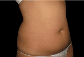 Liposuction Before and After Pictures West Palm Beach, FL (Dr. Eidelman)