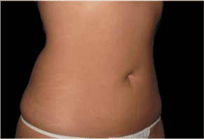 Liposuction Before and After Pictures West Palm Beach, FL (Dr. Eidelman)