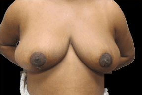 Breast Reduction Before and After Pictures West Palm Beach, FL (Dr. Eidelman)