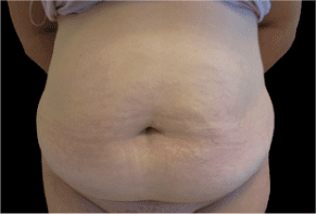 Tummy Tuck Before and After Pictures West Palm Beach, FL (Dr. Hayn)