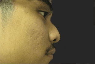 Rhinoplasty Before and After Pictures West Palm Beach, FL (Dr. Hayn)