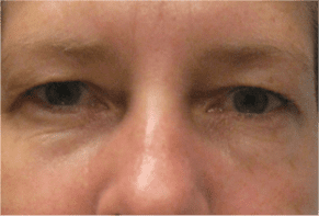 Blepharoplasty Before and After Pictures West Palm Beach, FL (Dr. Pillersdorf)