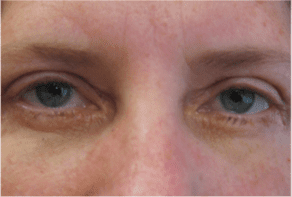 Blepharoplasty Before and After Pictures West Palm Beach, FL (Dr. Pillersdorf)