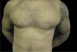 Gynecomastia Before and After Pictures West Palm Beach, FL (Dr. Pillersdorf)