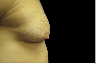 Gynecomastia Before and After Pictures West Palm Beach, FL (Dr. Pillersdorf)