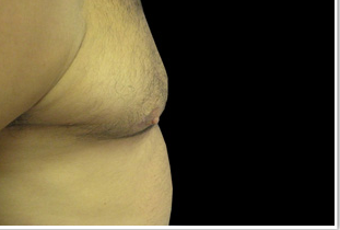 Gynecomastia Before and After Pictures West Palm Beach, FL (Dr. Pillersdorf)
