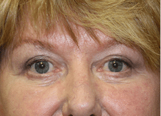 Blepharoplasty Before and After Pictures West Palm Beach, FL (Dr. Eidelman)