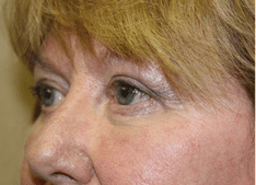 Blepharoplasty Before and After Pictures West Palm Beach, FL (Dr. Eidelman)