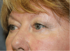 Blepharoplasty Before and After Pictures West Palm Beach, FL (Dr. Eidelman)