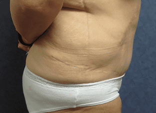 Tummy Tuck Before and After Pictures West Palm Beach, FL (Dr. Hayn)