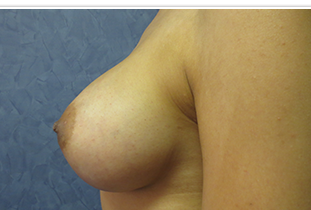 Breast Augmentation Before and After Pictures West Palm Beach, FL (Dr. Hayn)