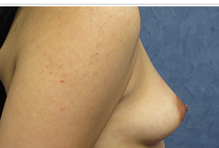Breast Augmentation Before and After Pictures West Palm Beach, FL (Dr. Hayn)