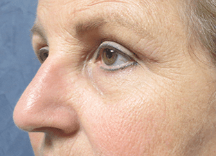 Blepharoplasty Before and After Pictures West Palm Beach, FL (Dr. Hayn)