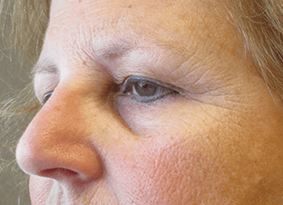 Blepharoplasty Before and After Pictures West Palm Beach, FL (Dr. Hayn)