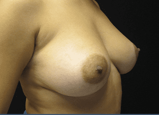 Breast Augmentation Before and After Pictures West Palm Beach, FL (Dr. Navarro)