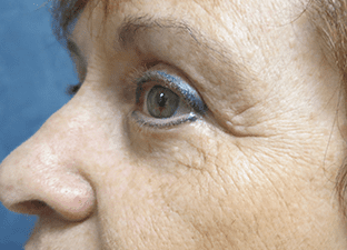 Blepharoplasty Before and After Pictures West Palm Beach, FL (Dr. Pillersdorf)