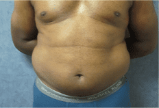 Liposuction Before and After Pictures West Palm Beach, FL (Dr. Hayn)