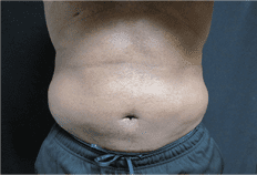 Liposuction Before and After Pictures West Palm Beach, FL (Dr. Hayn)