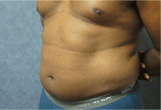 Liposuction Before and After Pictures West Palm Beach, FL (Dr. Hayn)