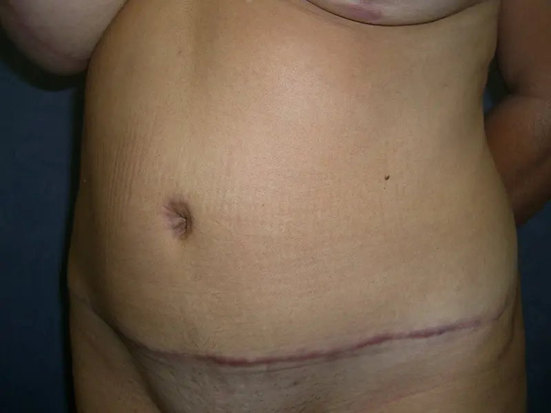 Breast Augmentation with Mastopexy, Abdominoplasty and Mommy Makeover Before and After Pictures in West Palm Beach, FL