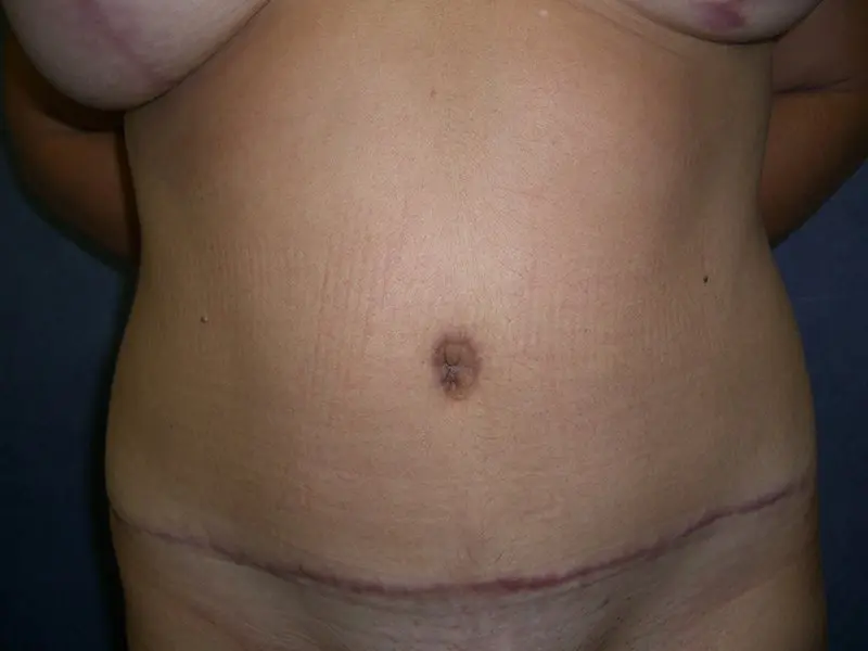 Breast Augmentation with Mastopexy, Abdominoplasty and Mommy Makeover Before and After Pictures in West Palm Beach, FL