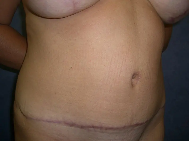 Breast Augmentation with Mastopexy, Abdominoplasty and Mommy Makeover Before and After Pictures in West Palm Beach, FL