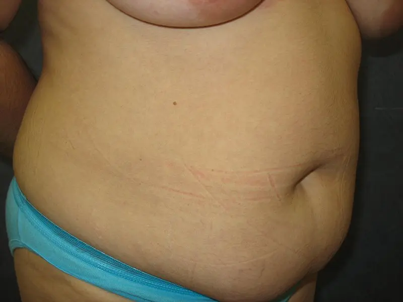 Breast Augmentation with Mastopexy, Abdominoplasty and Mommy Makeover Before and After Pictures in West Palm Beach, FL