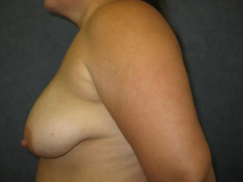 Breast Augmentation with Mastopexy, Abdominoplasty and Mommy Makeover Before and After Pictures in West Palm Beach, FL