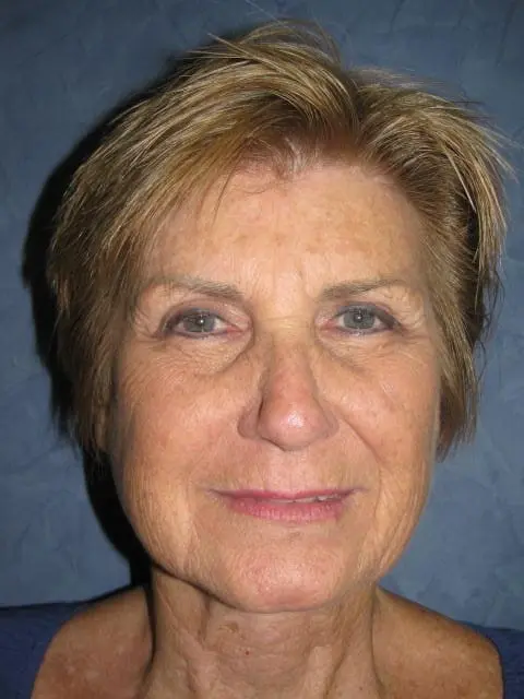 Facelift Before and After Pictures West Palm Beach, FL