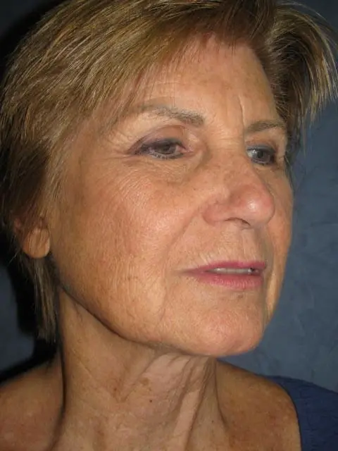 Facelift Before and After Pictures West Palm Beach, FL