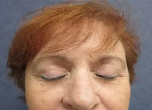 Blepharoplasty Before and After Pictures West Palm Beach, FL (Dr. Pillersdorf)