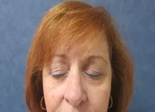 Blepharoplasty Before and After Pictures West Palm Beach, FL (Dr. Pillersdorf)