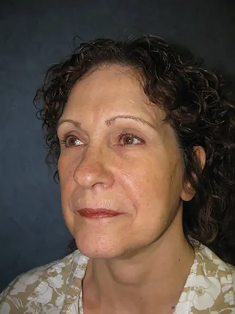 FaceLift Before and After Pictures in West Palm Beach, FL