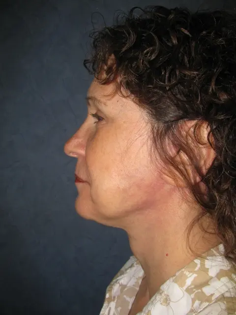 FaceLift Before and After Pictures in West Palm Beach, FL