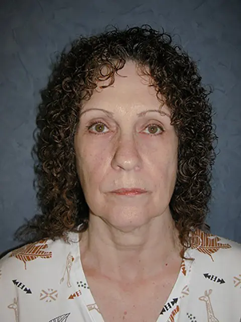 FaceLift Before and After Pictures in West Palm Beach, FL