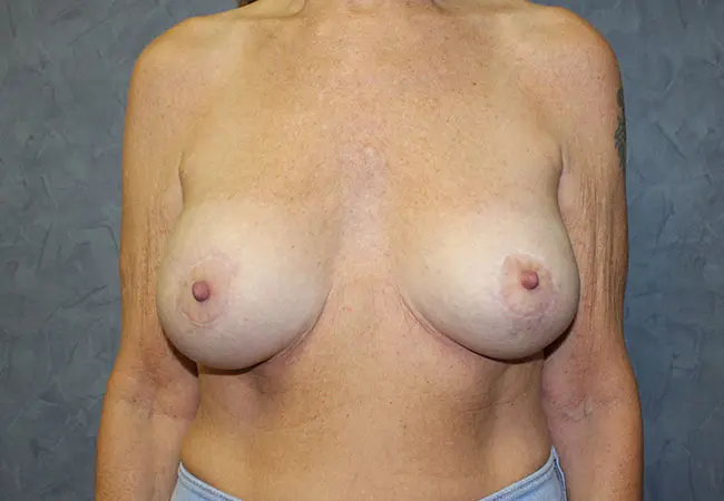 Breast Augmentation with Mastopexy Case Before and After Pictures in West Palm Beach, FL