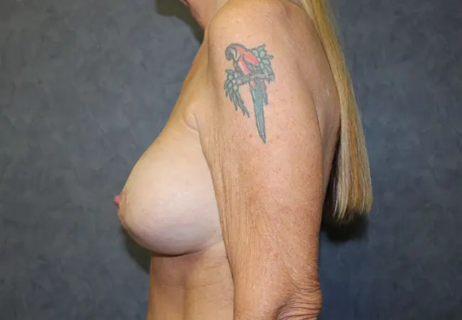 Breast Augmentation with Mastopexy Case Before and After Pictures in West Palm Beach, FL