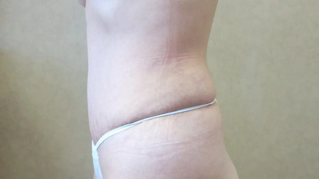 Abdominoplasty Before and After Pictures West Palm Beach, FL
