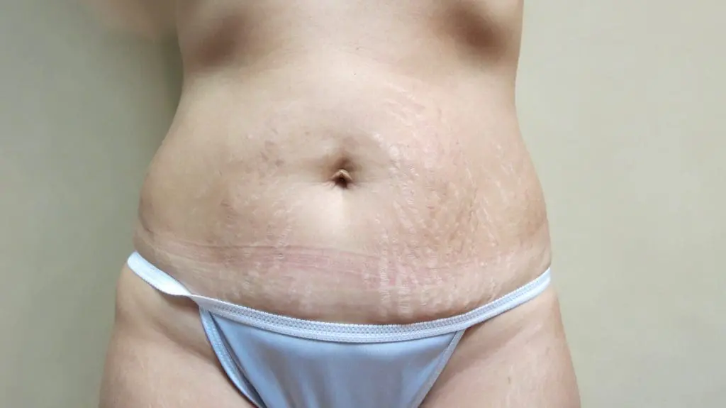 Abdominoplasty Before and After Pictures West Palm Beach, FL