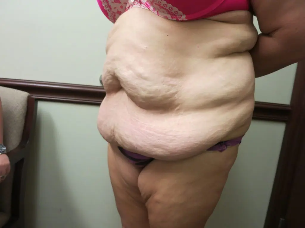 Abdominoplasty Breast Augmentation Before and After Pictures West Palm Beach, FL