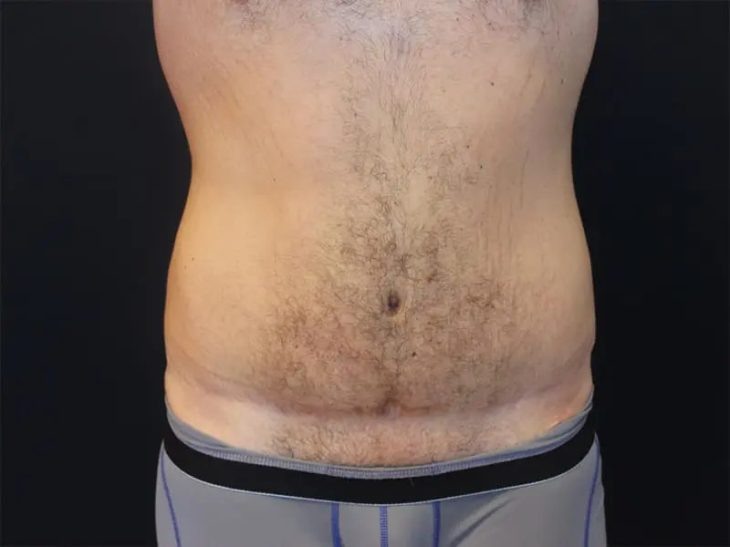 Abdominoplasty Before and After Pictures West Palm Beach, FL