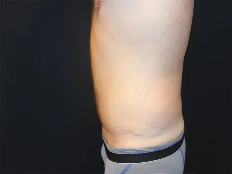 Abdominoplasty Before and After Pictures West Palm Beach, FL