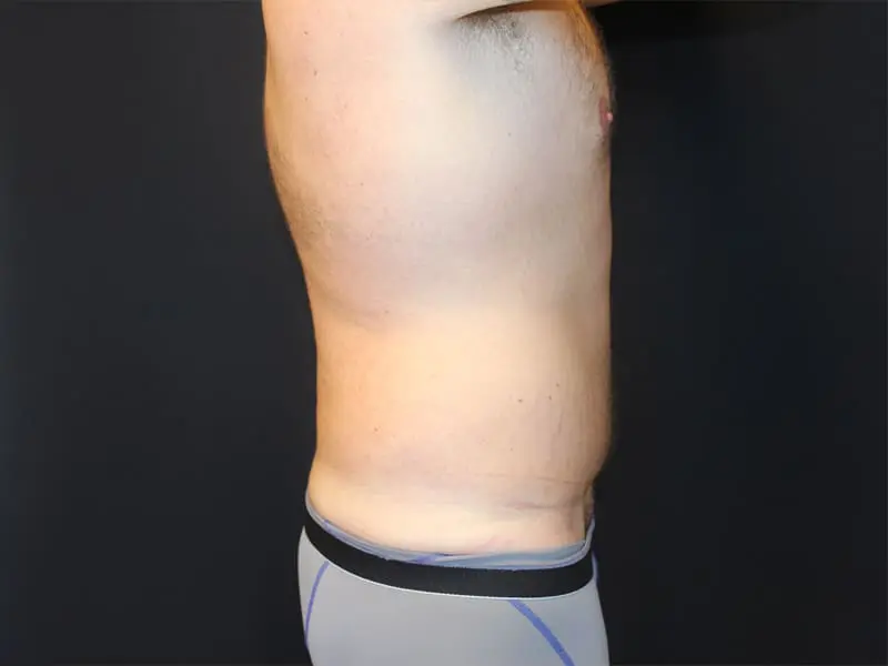 Abdominoplasty Before and After Pictures West Palm Beach, FL