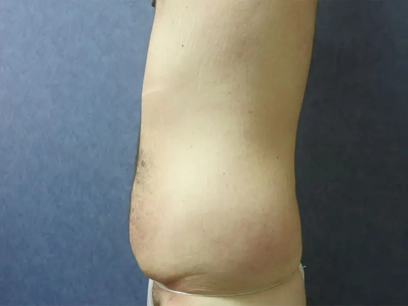 Abdominoplasty Before and After Pictures West Palm Beach, FL